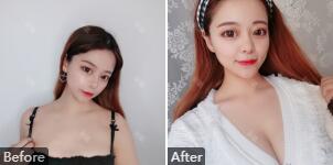 北京八大处李发成吸脂怎么样？李发成出诊时间_吸脂面填案例_价格
