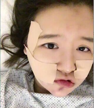 北医三院毕洪森整形技术怎么样?毕洪森面部吸脂瘦脸案例_价格_门诊时间