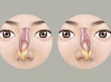 成都隆鼻整形价格费用多少？解析鼻部整形费用