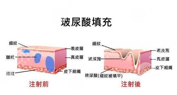 济南美莱整形医院价目表曝光，玻尿酸等热门项目多少钱？