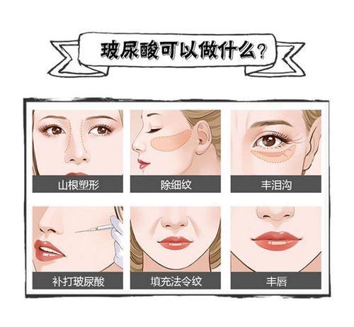 金堂打玻尿酸多少钱一针？一般情况下大概需要2000元到4000元一针
