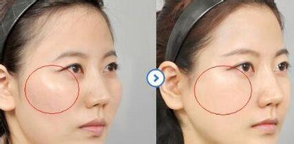 大庆颧骨磨骨整形的价格,大庆颧骨磨骨整形需要价格大约是多少