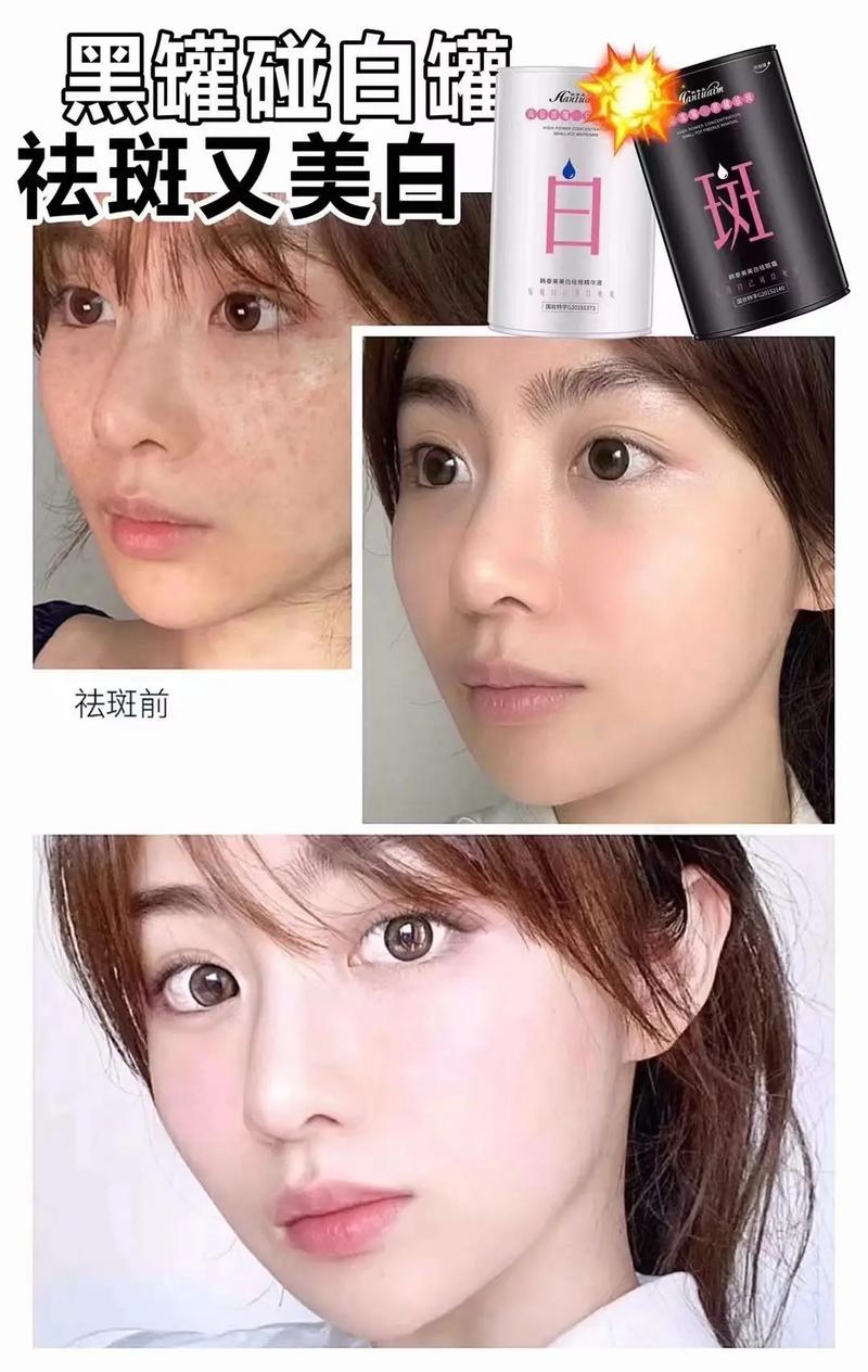 佛山负责人民医院美容科祛斑价目表新版已发布！附激光美容案例