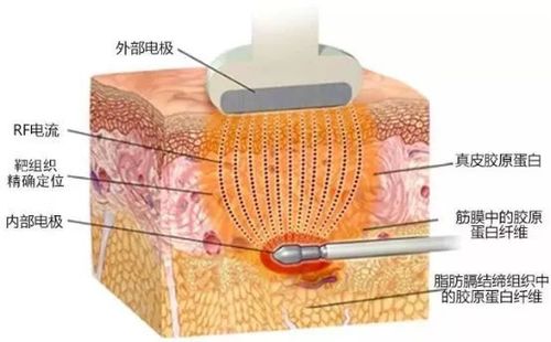 深蓝射频除皱技术怎么样？价格费用多少？一文解析