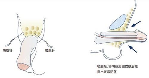 太原丽都医疗美容医院好吗？吸脂案例分享+相关问答