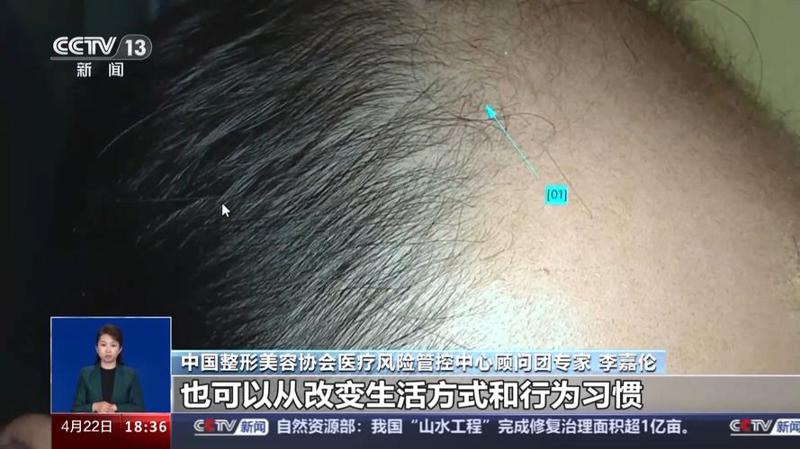 太原哪家医院治疗脱发好 比较好的植发机构