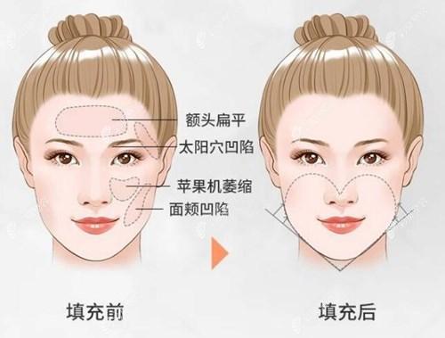 孙力整形医生-双鸭山市孙力医生自体脂肪丰全脸价格高但很值