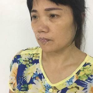 「河北省人民医院医疗美容科李兵」怎么样?擅长|案例|价格表