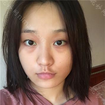 南京华美整形美容医院吴文欢线雕怎么样