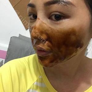 天津哪家医院做膨体隆眉弓效果好？排行前三不仅看医院实力！