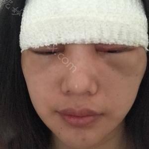 天津哪家医院做膨体隆眉弓效果好？排行前三不仅看医院实力！