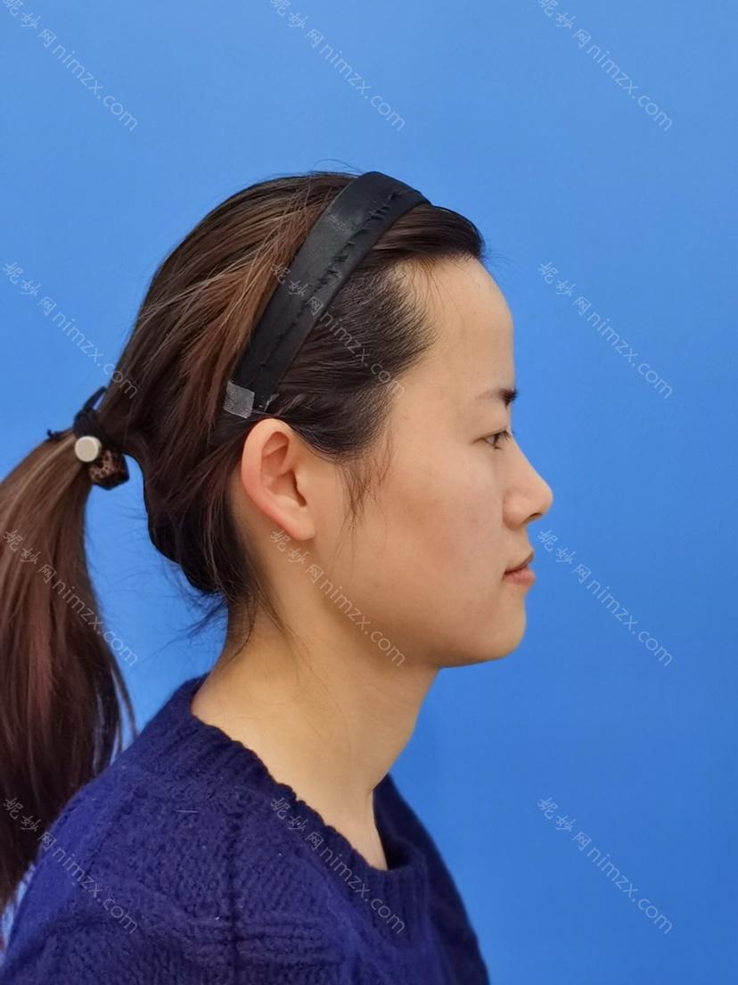 天津哪家医院做下颚前突手术好？当属南开欧菲、西青区希尔思、和平丽惠泽医学这三家!价格(案例)盘点！