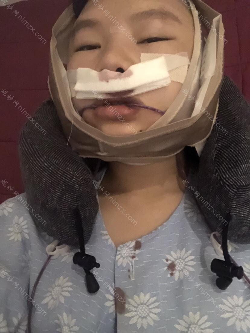 天津哪家医院做下颚前突手术好？当属南开欧菲、西青区希尔思、和平丽惠泽医学这三家!价格(案例)盘点！