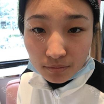 南京华美美容医院裴旭芳开双眼皮怎么样