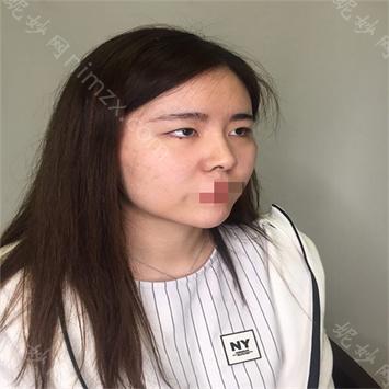 南京华美整形美容医院王小林做眼睛怎么样