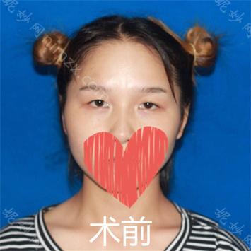 南京华美美容医院（旗舰店）曹海峰割双眼皮怎么样