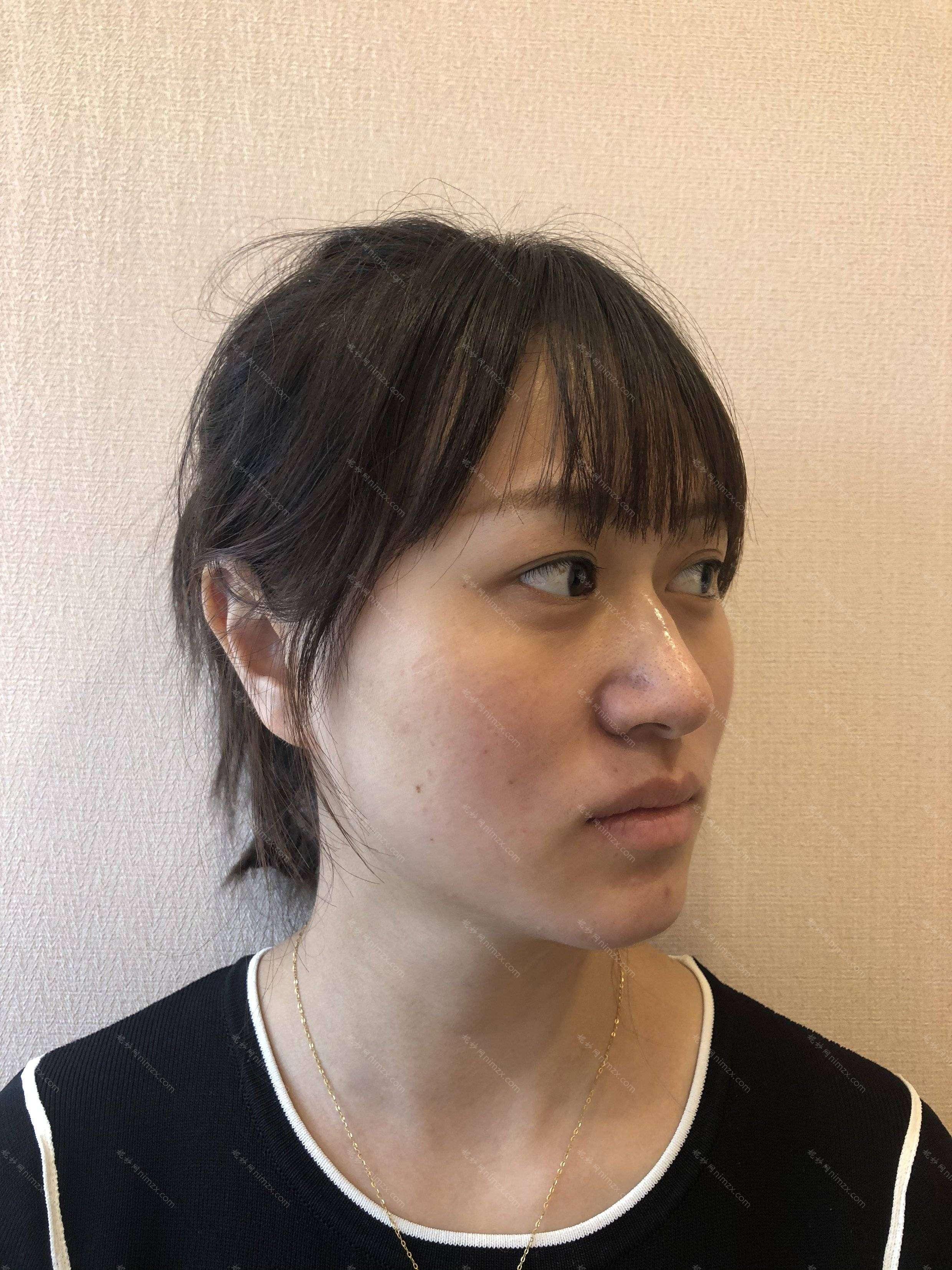 天津哪家医院做玻尿酸垫鼻基底较好？排名前十强口碑亮眼~送上案例及价格表做比较！