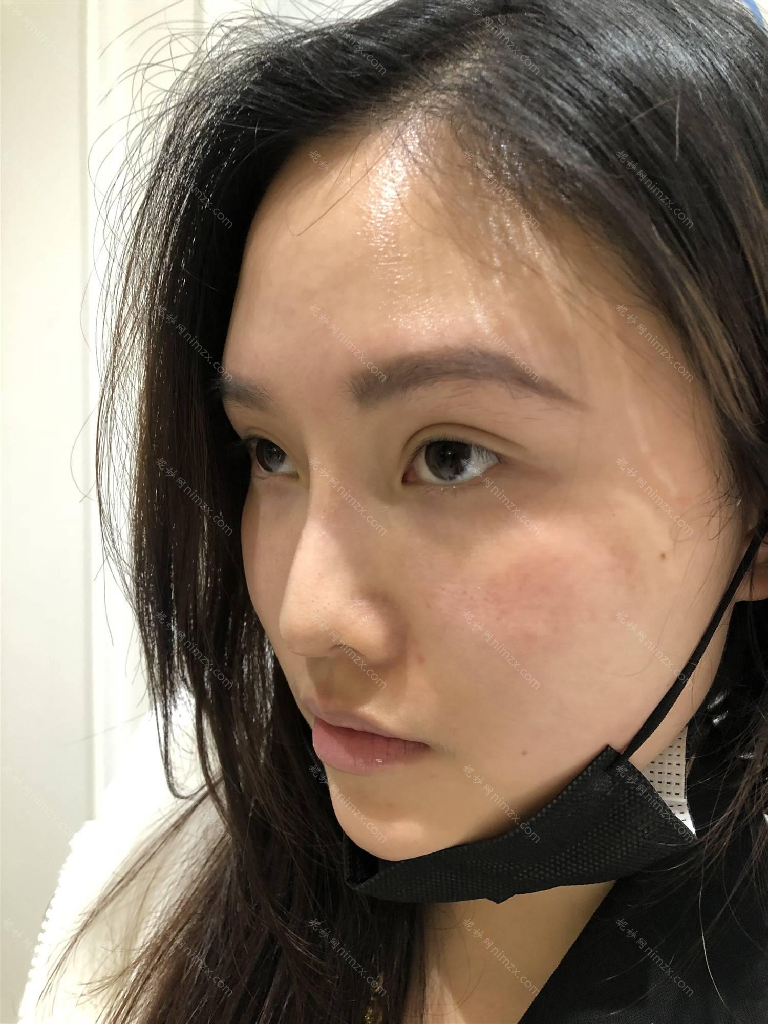 天津哪家医院做玻尿酸垫鼻基底较好？排名前十强口碑亮眼~送上案例及价格表做比较！