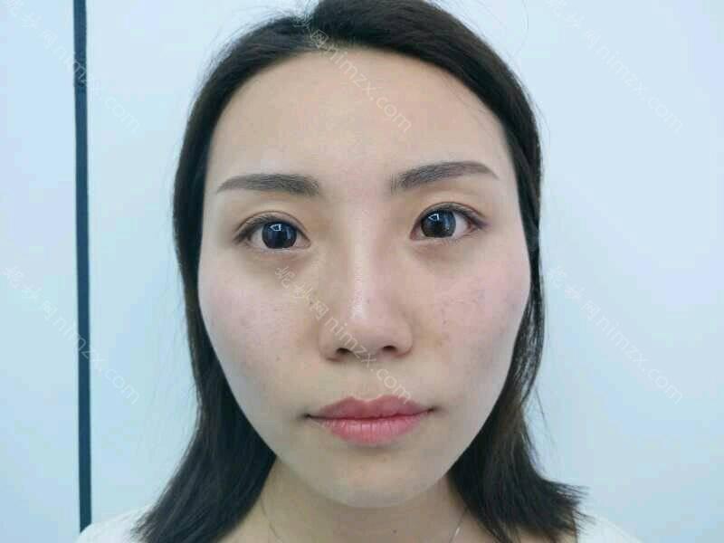 天津哪家医院做玻尿酸垫鼻基底较好？排名前十强口碑亮眼~送上案例及价格表做比较！