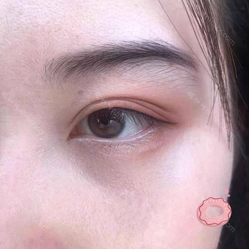天津哪家医院做内切去眼袋手术较好？正规排名榜盘点前四_价格清单一一出示!！