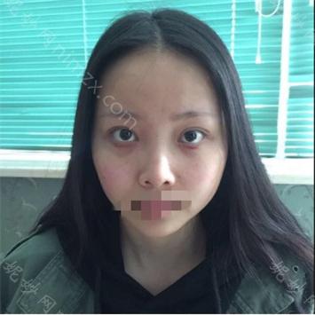 南京华美医疗美容整形医院曹海峰鼻子修复案例