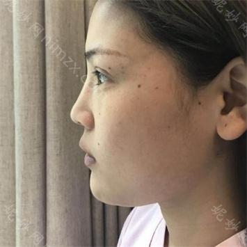 南京华美整形美容医院曹海峰怎么样