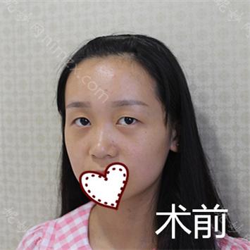 南京华美医疗美容整形医院曹海峰做眼睛怎么样