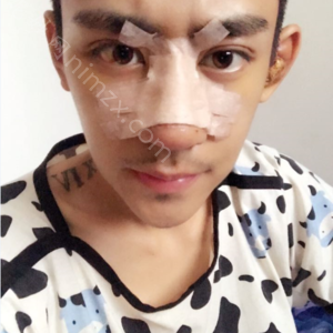 天津哪家医院做驼峰鼻矫正术好看？知妍、美联致美、伊美木子等实力在线比较!！