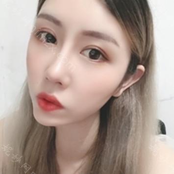 南京华美美容医院沈正宇双眼皮做得好吗