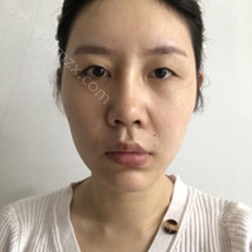 南京华美美容医院沈正宇双眼皮做得好吗