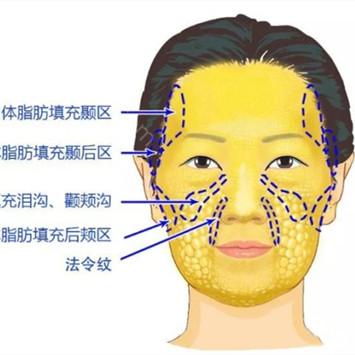 南京华美美容医院沈正宇脂肪填充怎么样