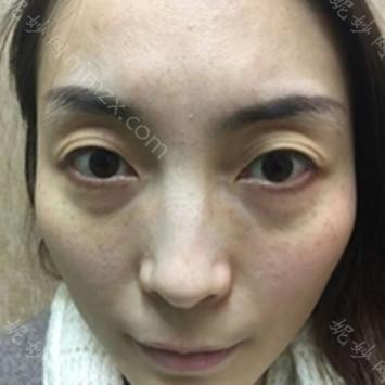 南京华美美容医院沈正宇脂肪填充怎么样