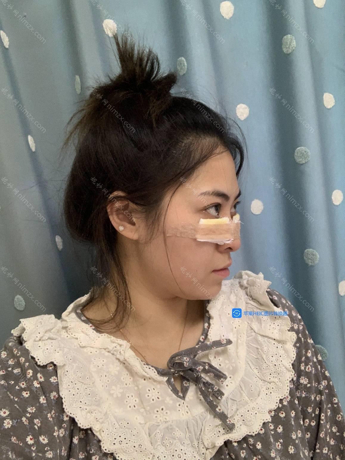天津哪家医院做外切去眼袋比较靠谱？排名榜整理5位医院大咖!天津市第四医院、伊美尔、河东菲丝澜医学等任选！