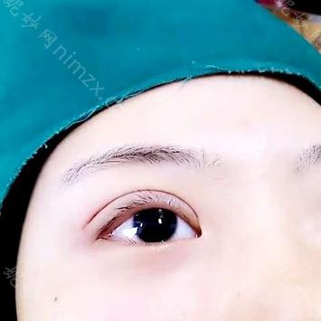南京华美美容医院王小林眼综合做得怎么样