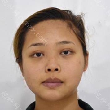 南京华美美容医院王小林双眼皮修复案例