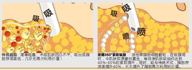 南京华美美容医院曹海峰做肋骨鼻怎么样