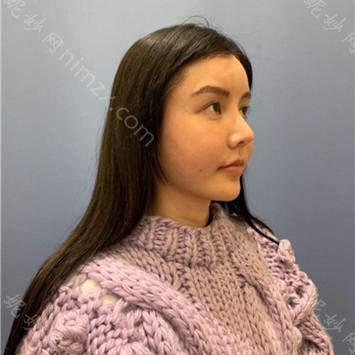 南京华美美容医院沈正宇做鼻修复手术怎么样