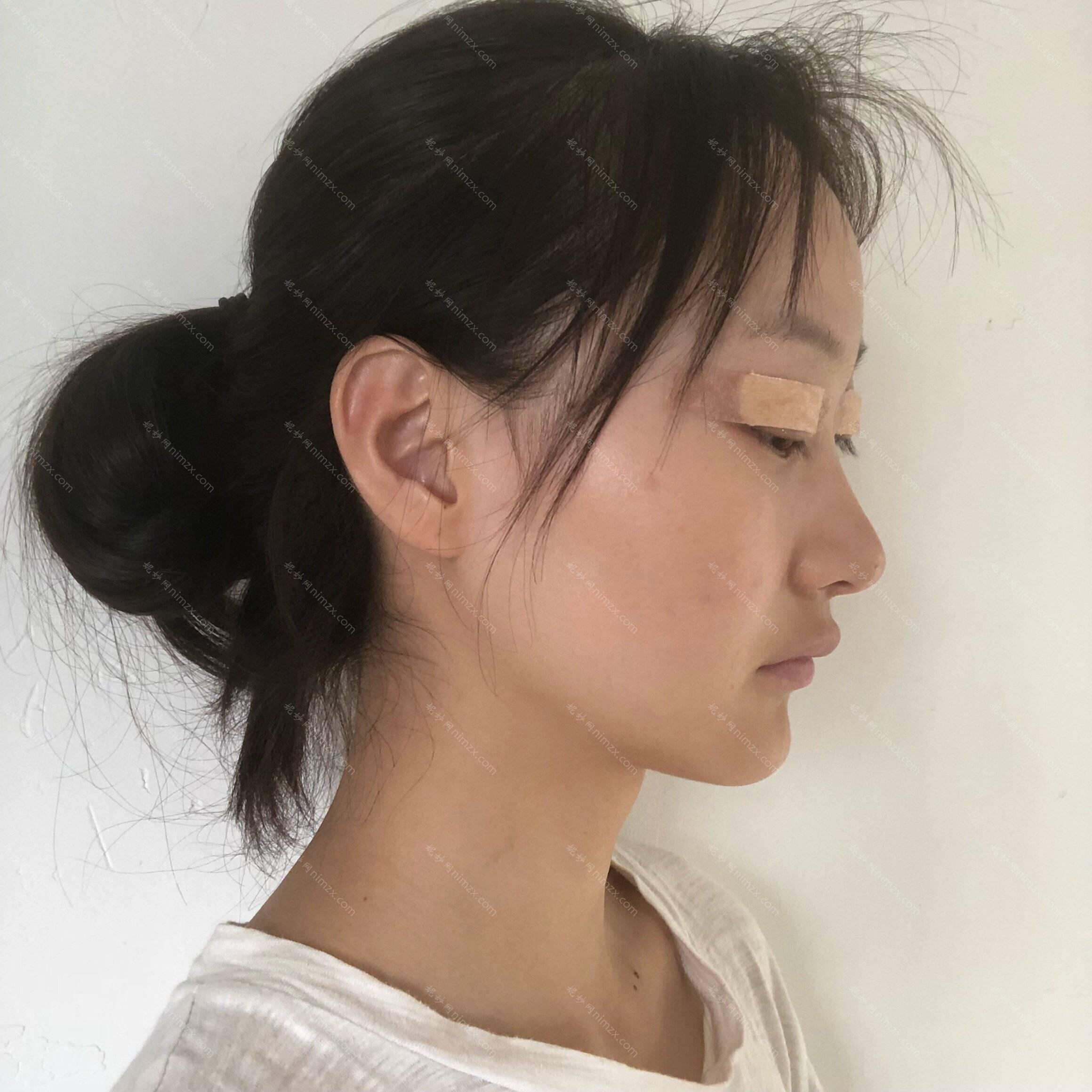 天津哪家医院做开外眼角好看？排名前五医院评点_附手术价格查询！