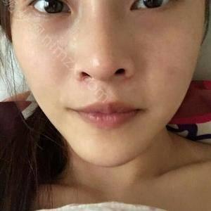 天津哪家医院做无痕开眼角效果比价好？排名前三晗熙、天津河东丽人医院、和平薇什都有资质_专家实力不浅!！