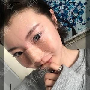 广东哪家医院做曼特波假体隆鼻好？2020-还有整曼特波假体隆鼻价格案例参考哦!！