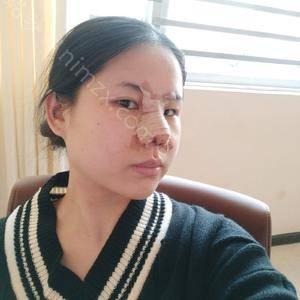 广东哪家医院做膨体假体隆鼻靠谱？10强医院口碑特色各不同~价格收费合理！