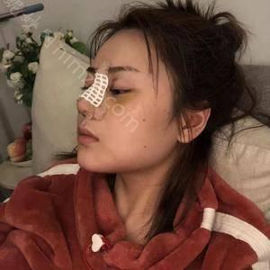 广东哪家医院做膨体假体隆鼻靠谱？10强医院口碑特色各不同~价格收费合理！