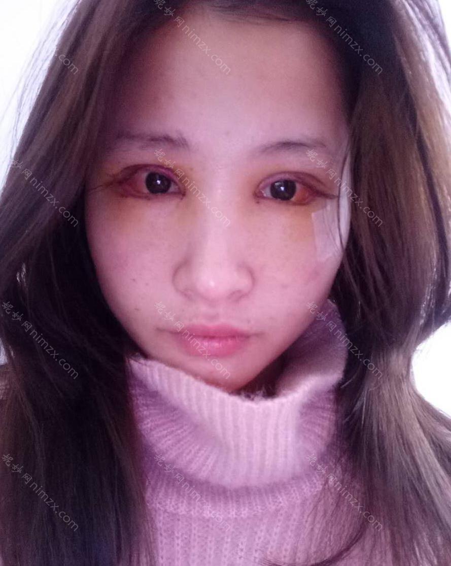 天津哪家医院做内眼角修复效果好？排名前十强口碑亮眼~送上案例及价格表做比较！