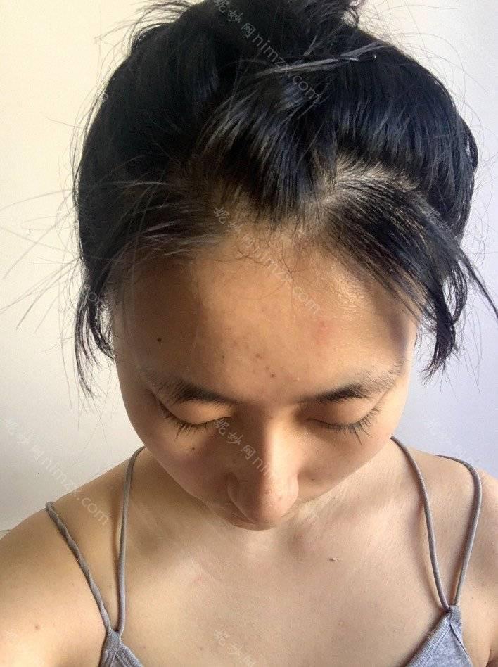 天津哪家医院做开外眼角好看？排名前五医院评点_附手术价格查询！