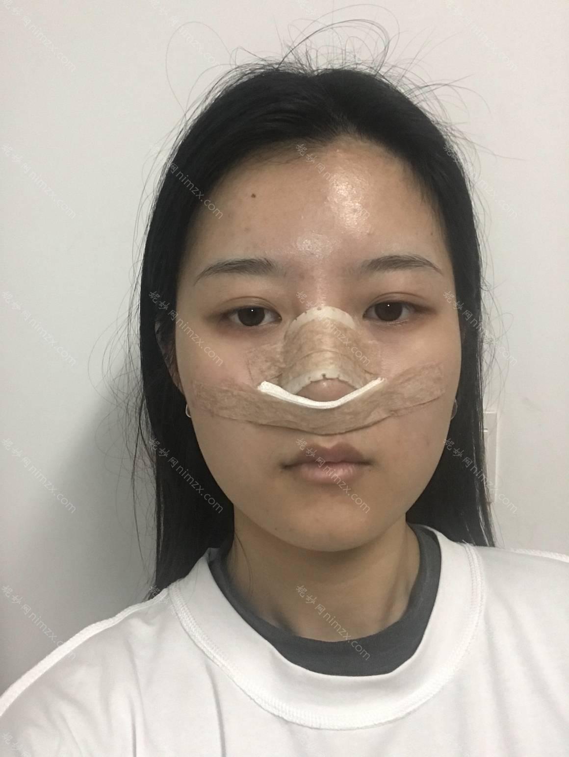 广东哪家医院做耳软骨复合隆鼻比较好？正规排名榜盘点前四_价格清单一一出示!！