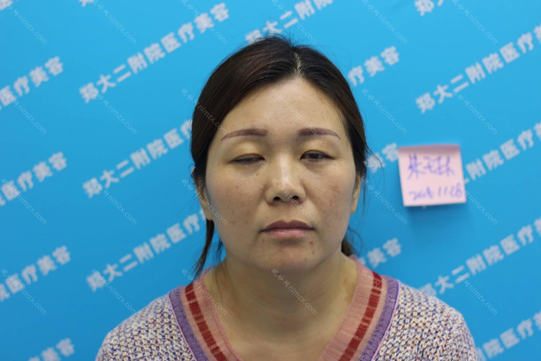 广东哪家医院做眼皮下垂矫正靠谱？圣浩、东莞市莞城医院、希思等实力在线比较!！