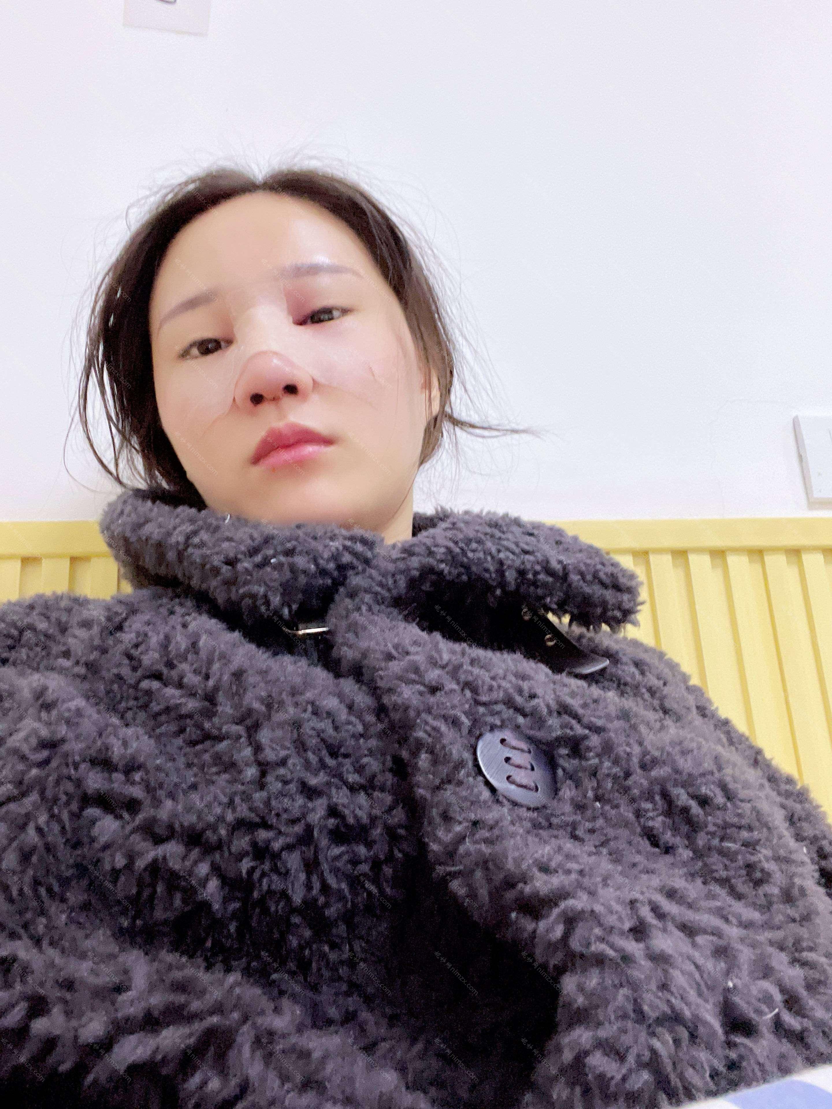 广东哪家医院做膨体垫鼻基底好看？排名前五口碑医院盘点_圣悦、杨恰佳实力入围！