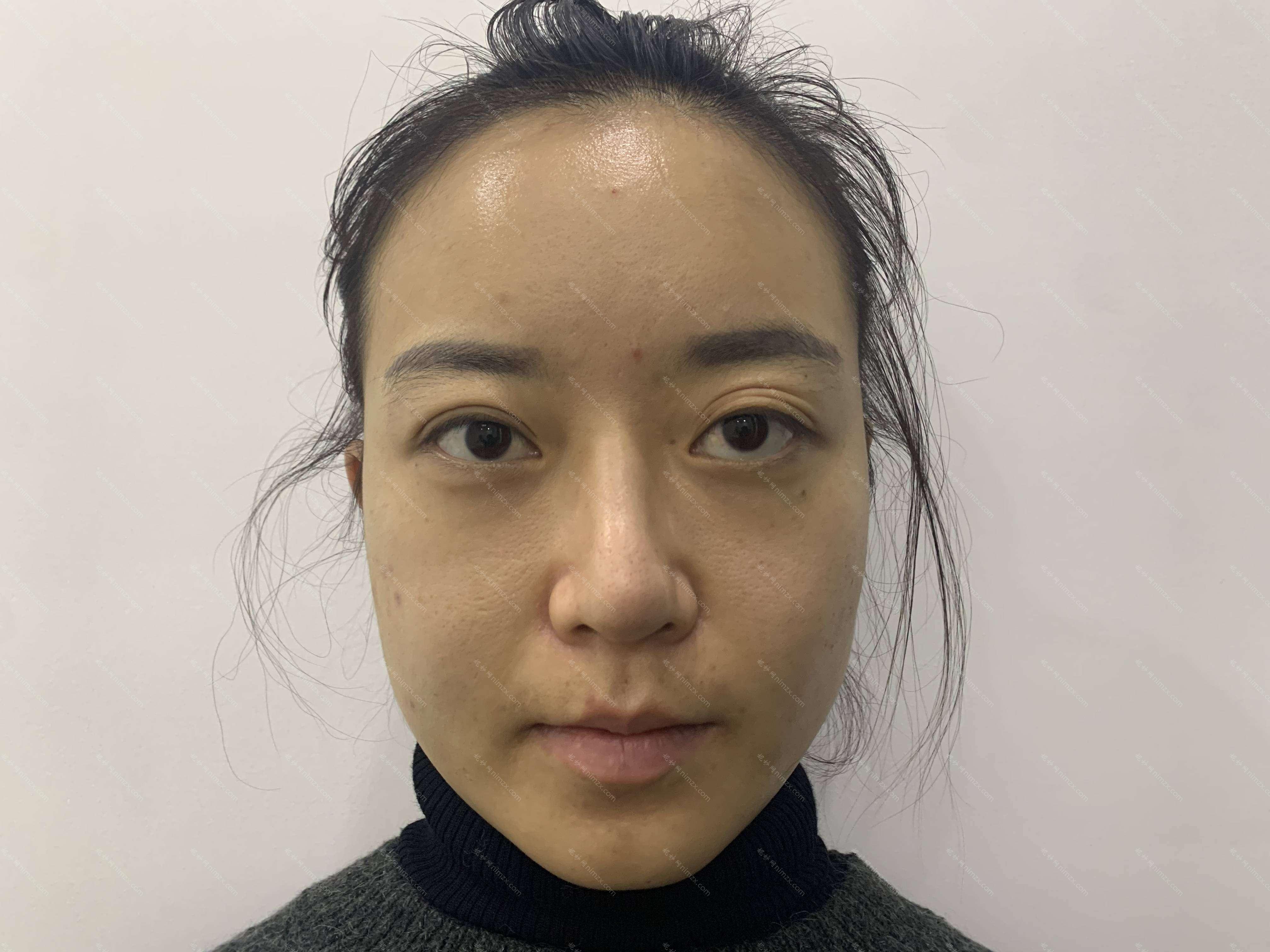 广东哪家医院做膨体垫鼻基底好看？排名前五口碑医院盘点_圣悦、杨恰佳实力入围！