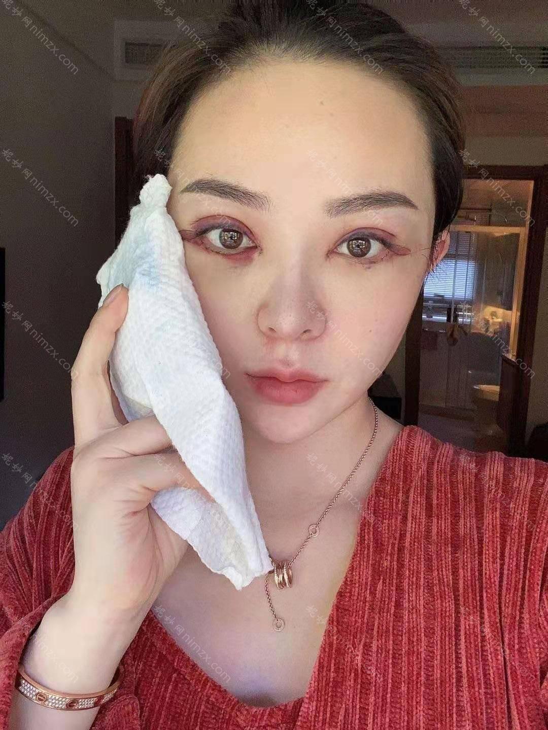 广东哪家医院做眼部修复好看？排名前五医院评点_附手术价格查询！