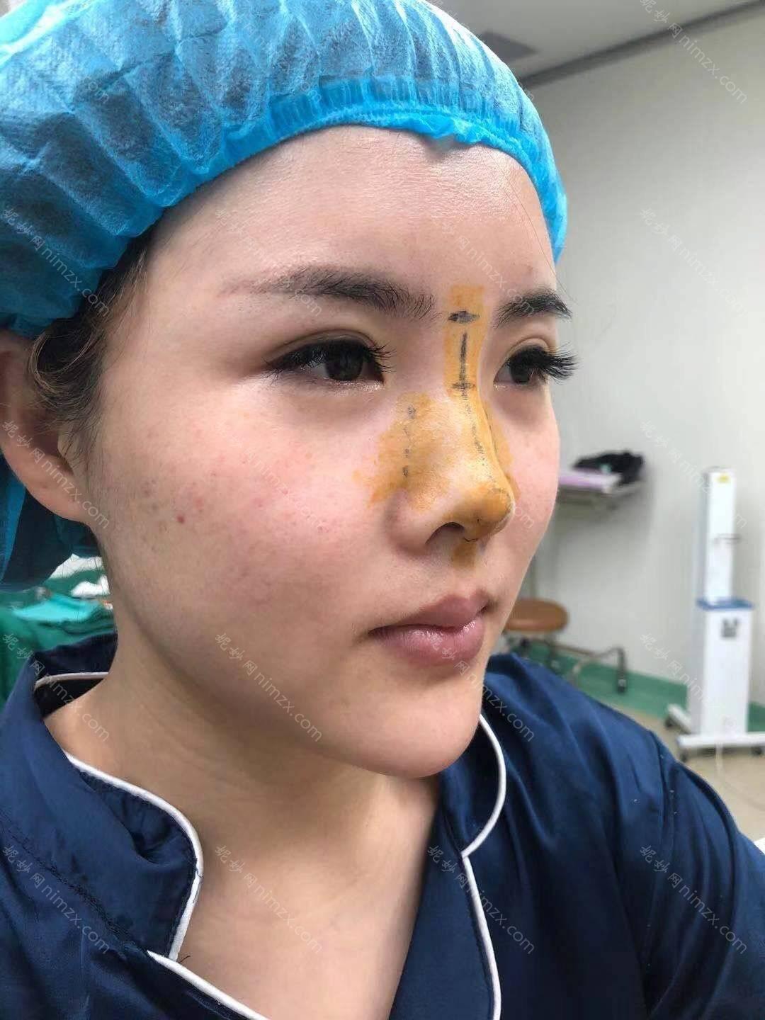 广东哪家医院做线雕隆鼻手术较好？排名前四权威医美口碑盘点_含手术价格查询！